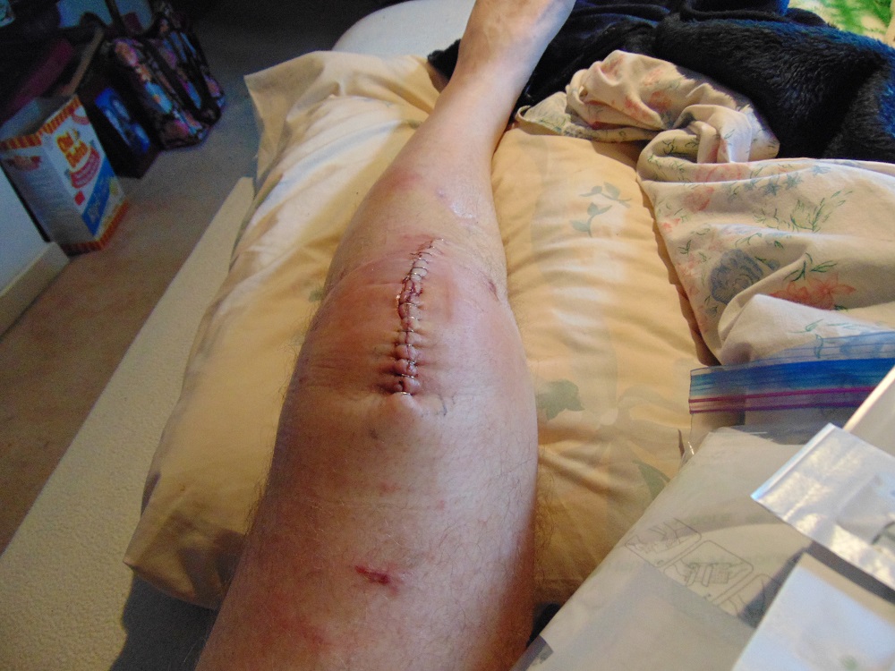 The New Knee The New Knee